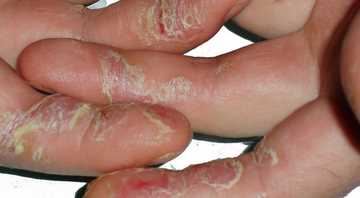 Профилактика трещин на пальцах рук и заусенцев