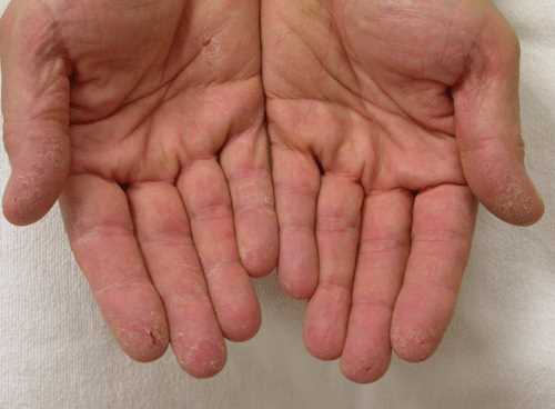 Как избавиться от заусенцев и трещин на пальцах рук