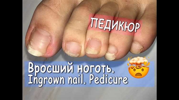 Как верно стричь и обрабатывать ногти, чтобы избежать вросших ногтей