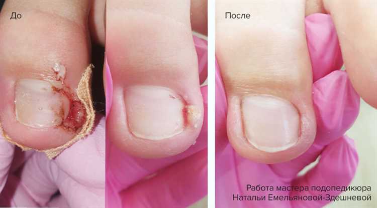 Как предотвратить врастание ногтей: основные правила