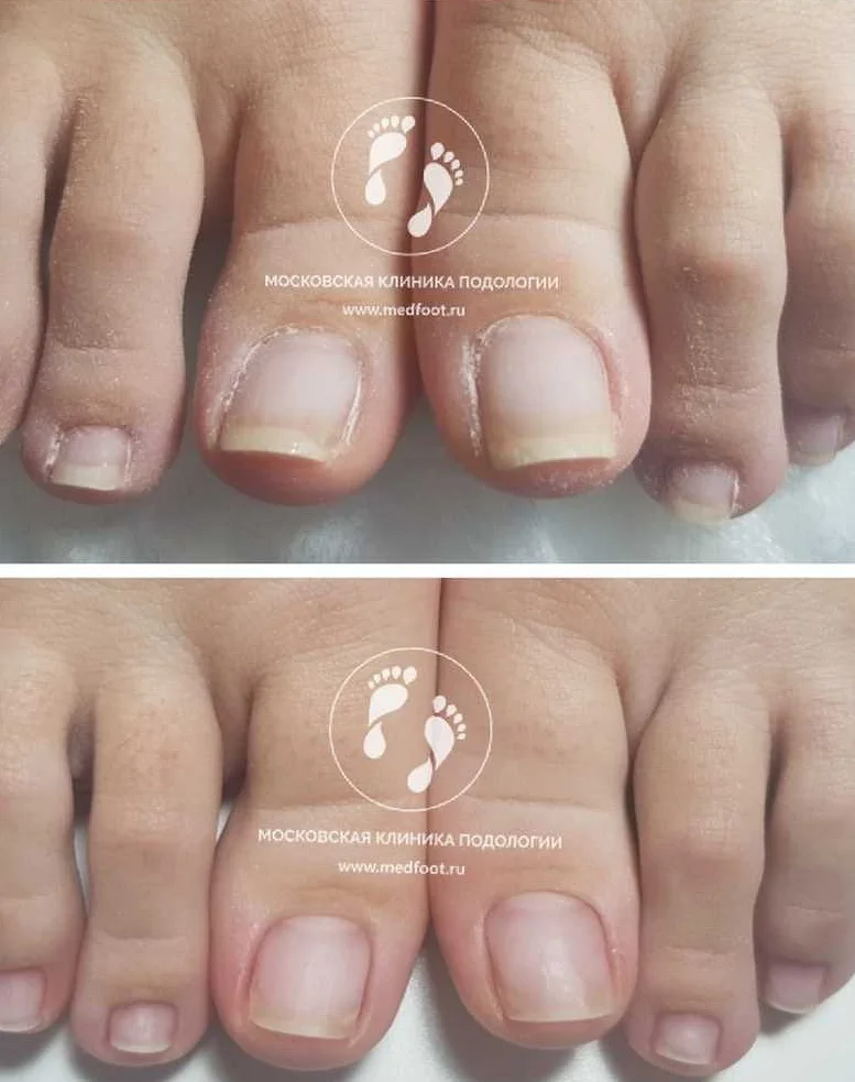 Что делать при врастании ногтя и когда следует обратиться к врачу