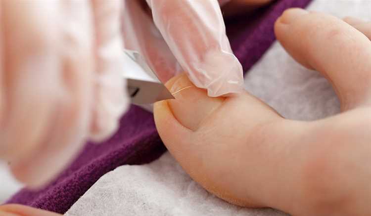 Уход за ногтями при наличии вросших ногтей: рекомендации врачей и профессионалов